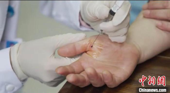 嘉善群眾體驗小針刀?！〖紊平y(tǒng)戰(zhàn) 供圖